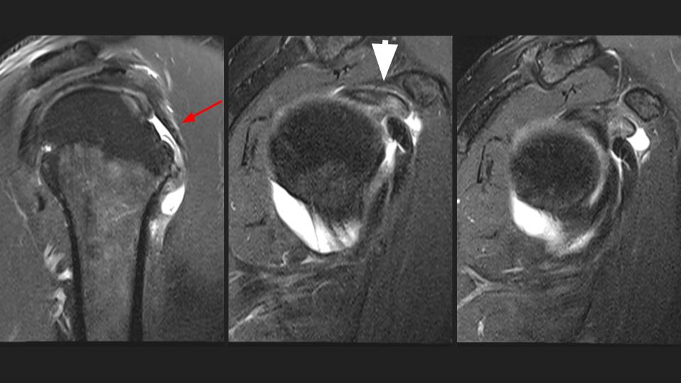 Figure 2 for case tendon of long head of biceps brachii ( RID1944 )